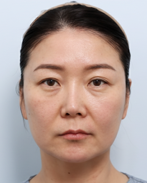수술 전 얼굴 정면 사진