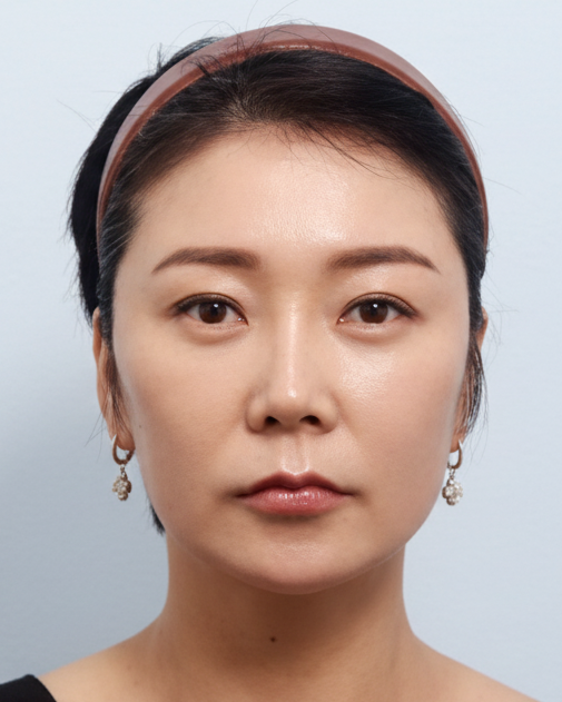 수술 후 얼굴 정면 사진 - 리프팅된 얼굴선