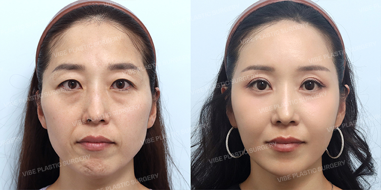 #눈썹밑거상 #자연유착 #하안검 #중안면거상 #풀페이스지방이식