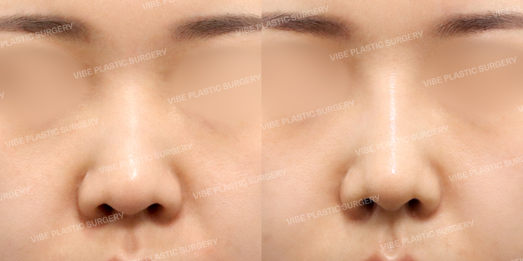 #콧대 #코끝 #기증늑 #복코 #비순각교정