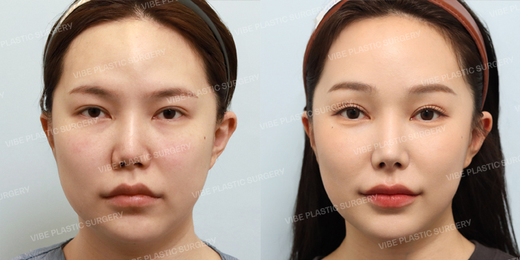 #코재수술 #콧대 #코끝 #자가늑 #찝힌코 #짧은코 #내시경이마거상술