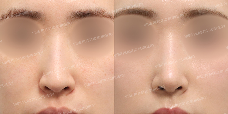 #무보형물코성형 #매부리 #하이코실제거