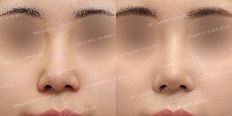 #무보형물코성형 #코끝 #매부리 #복코 #긴코