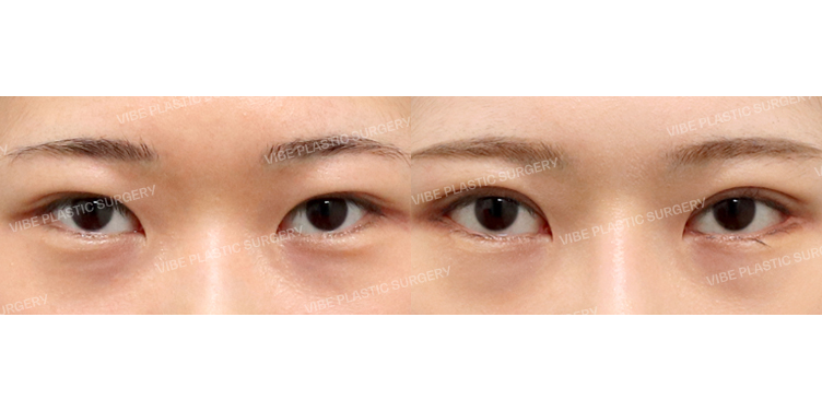 #부분절개쌍꺼풀(재수술) #뒤트임 #밑트임