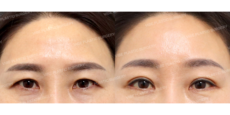 #내시경이마거상 #비절개눈매교정(재수술) #뒤트임 #밑트임