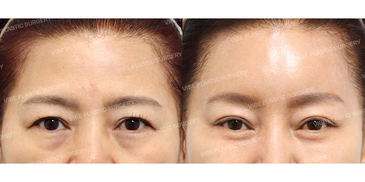 #내시경이마거상 #하안검 #부분절개쌍꺼풀 #얼굴지방이식