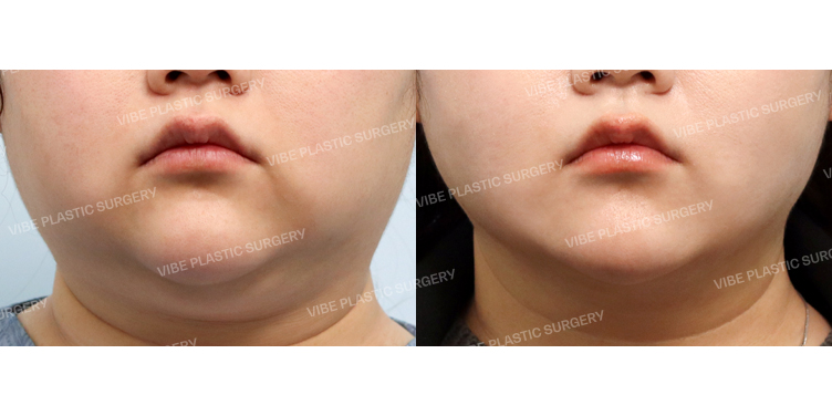 #초음파지방흡입(이중턱, 턱라인, 볼라인) #실리프팅