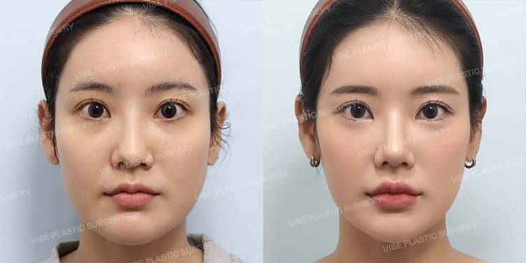 #무보형물코성형 #비중격 #진피이식 #이물질제거