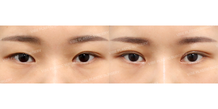 #부분절개쌍꺼풀(재수술) #앞트임(재수술)