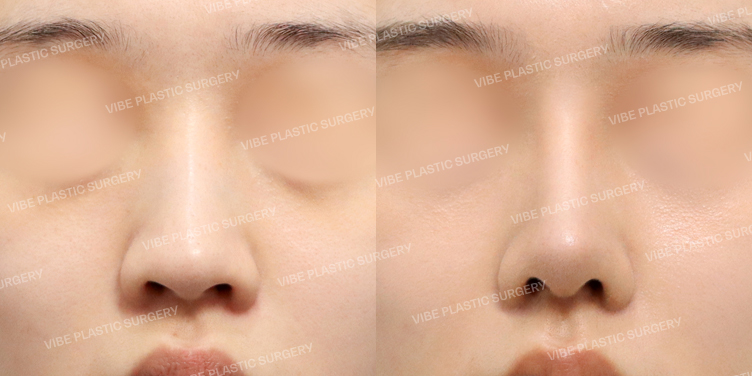 #무보형물코성형 #기증늑 #매부리 #절골 #긴코 #복코