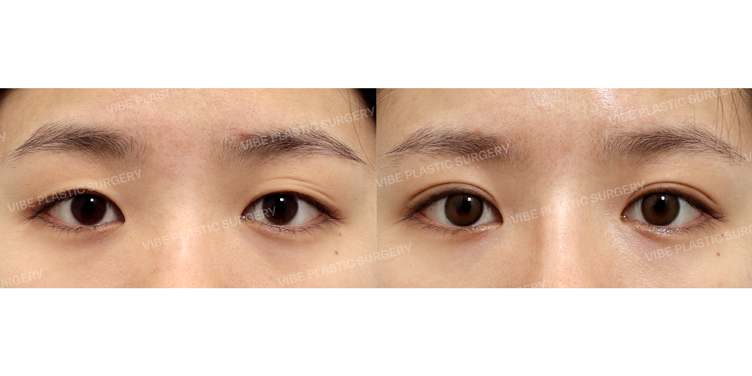 #부분절개쌍꺼풀