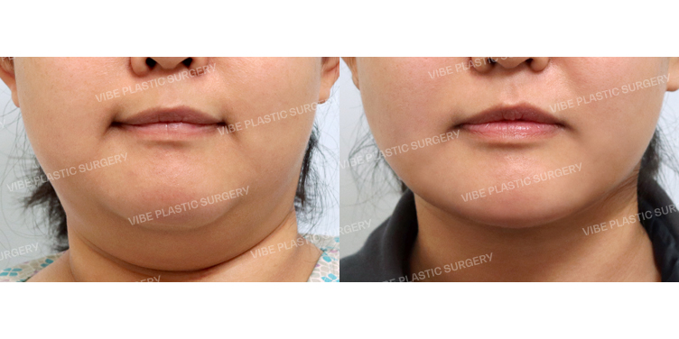 #초음파지방흡입(이중턱,턱라인) #목거상(이중턱근육묶기) #심부볼지방제거 #사각턱보톡스