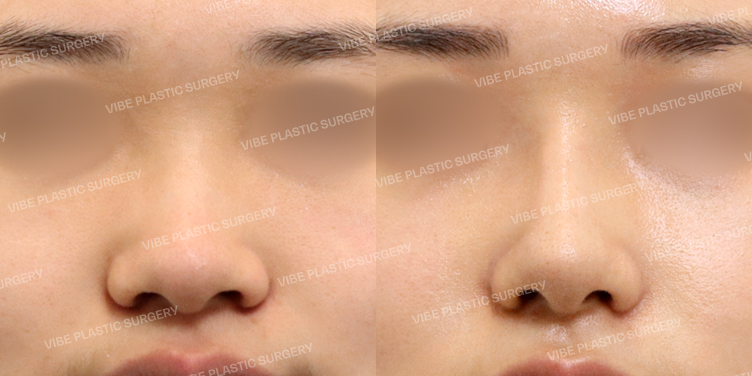 #콧대 #코끝 #복코 #비순각교정 #콧볼축소 #비중격