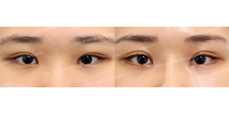 #앞트임 #뒤트임 #밑트임