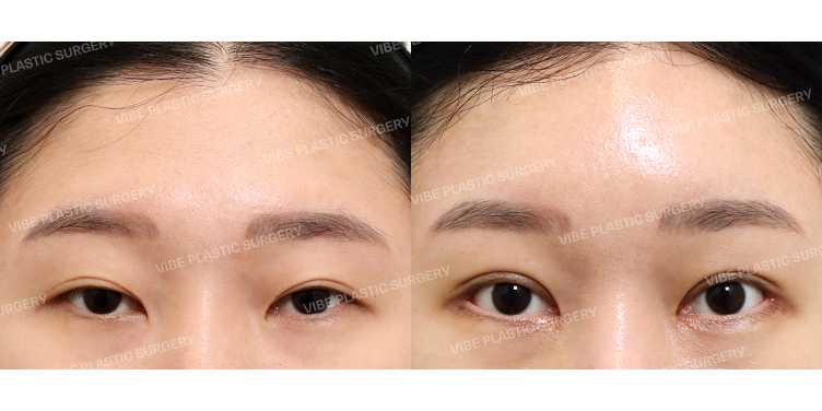 #내시경이마거상 #절개쌍꺼풀(재수술) #뒤밑트임