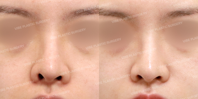 #비공내리기(재수술)