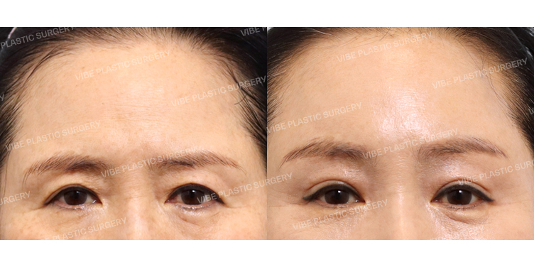 #내시경이마거상 #비절개눈매교정(재수술) #눈두덩이지방이식