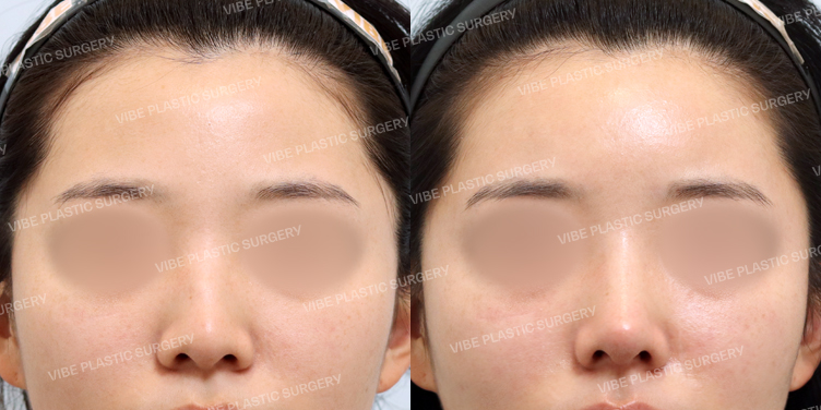 #지방이식(이마,관자) #무보형물 #비중격 #기증늑 #매부리코 #코끝교정 #이물질제거