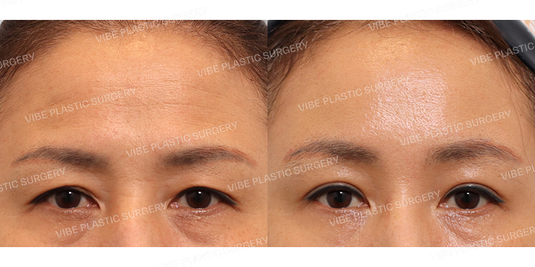 #자연유착 #내시강이마거상