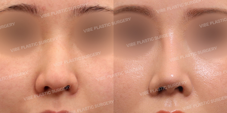 #낮은코 #매부리코 #복코 #휜코