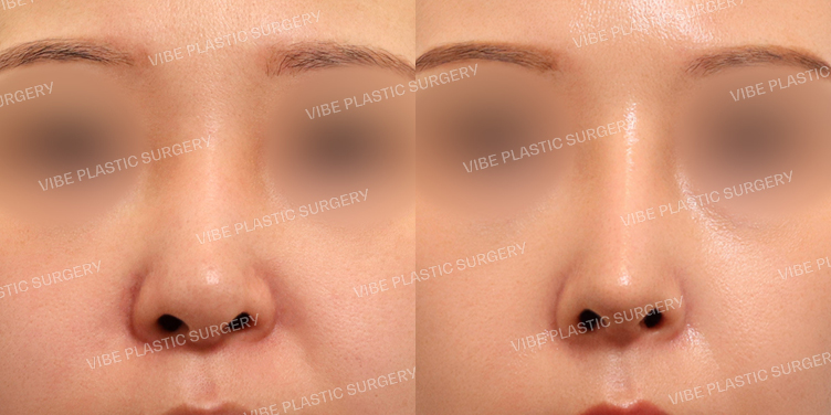 #코재수술 #휜코 #비공내리기