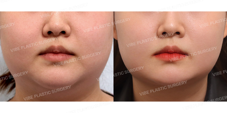 #초음파지방흡입(턱라인,이중턱,앞볼)