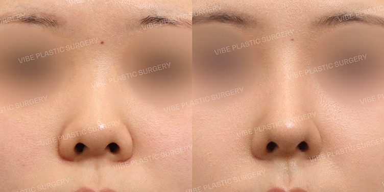 #짧은코 #복코 #콧대