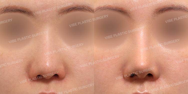 #코재수술 #복코 #비주교정 #비절개콧볼축소