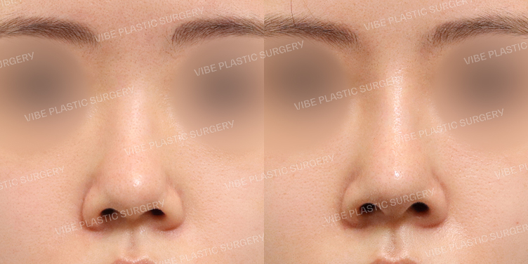 #콧대 #코끝 #복코