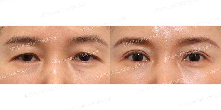 #상안검(재수술)