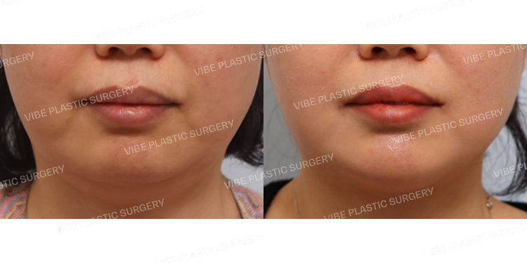 #초음파지방흡입(이중턱,턱라인)