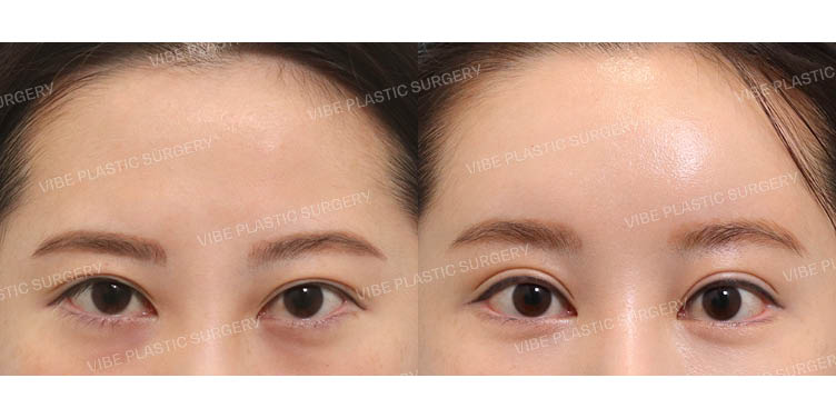 #절개눈매교정(재수술) #뒤밑트임(재수술) #내시경이마거상  #이마지방이식