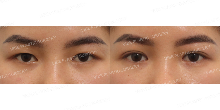 #부분절개눈매교정