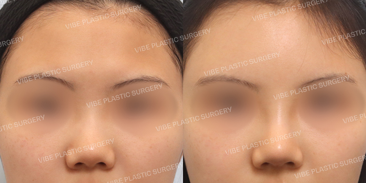 #이마지방이식 #낮은코