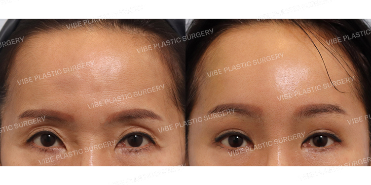 #눈두덩이지방이식 #내시경이마거상