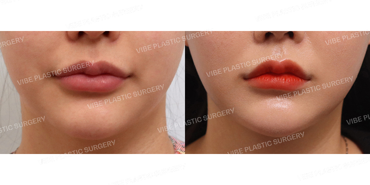 #초음파지방흡입(이중턱,턱라인)