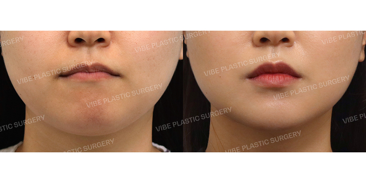 #초음파지방흡입(이중턱,턱라인)