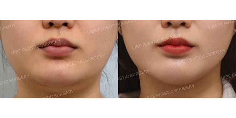 #초음파지방흡입(이중턱,턱라인) #슈링크