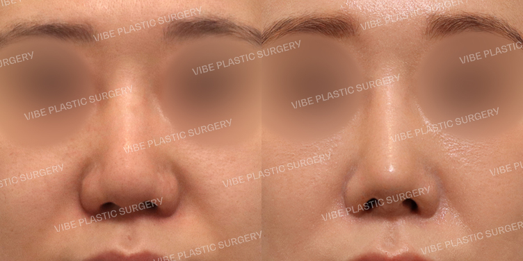 #코재수술 #복코 #코끝 #보형물교체