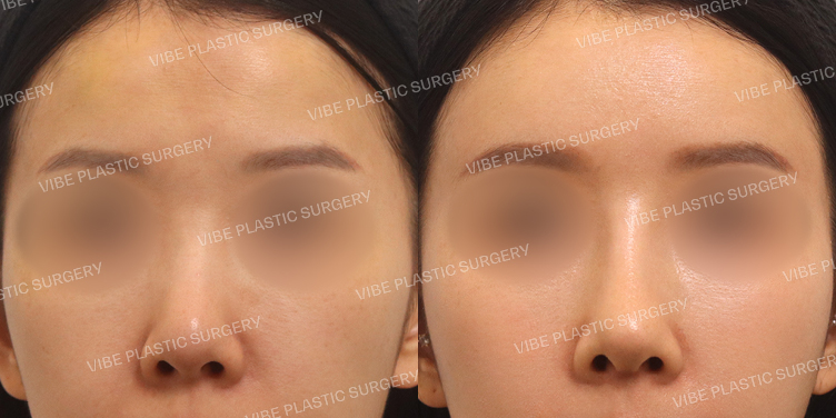 #짧은코 #풀페이스지방이식