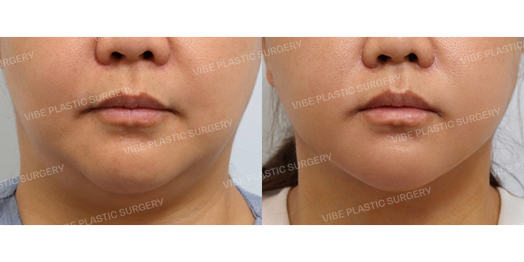 #목거상(이중턱근육묶기) #초음파지방흡입