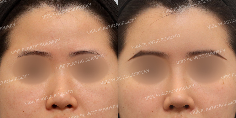 #이마지방이식 #낮은코