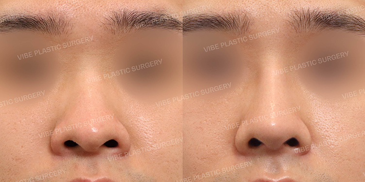 #콧대 #복코 #비주교정 #비절개콧볼축소