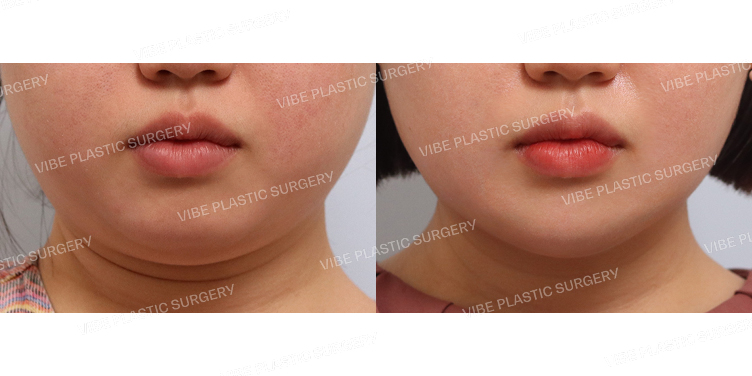 #초음파지방흡입(턱라인,이중턱,앞볼) #심부볼지방제거