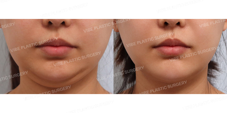 #초음파지방흡입(이중턱,턱라인)