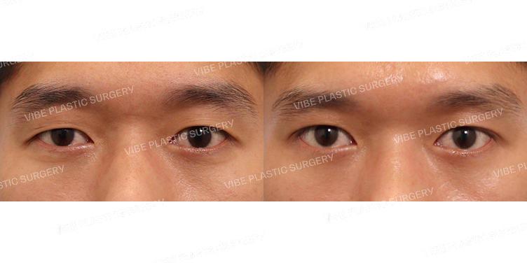 #비절개눈매교정