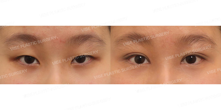 #비절개눈매교정 #앞트임