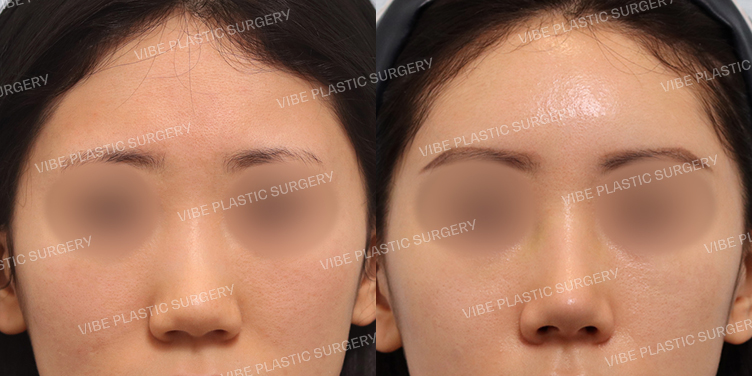 #풀페이스지방이식 #낮은코 #복코