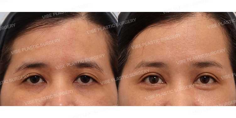 #내시경이마거상 #비절개눈매교정 #뒤트임 #밑트임 #하안검