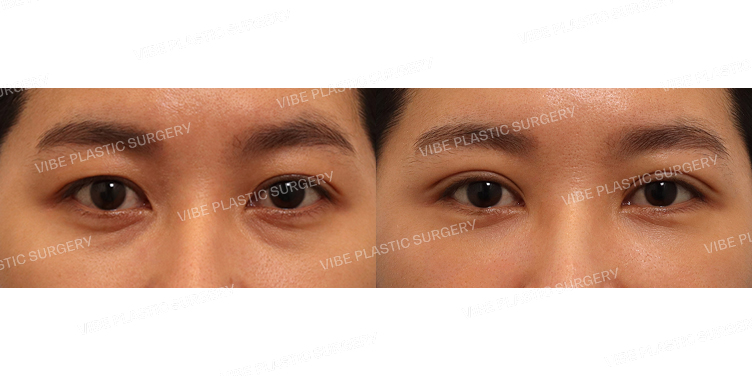 #자연유착 #눈밑지방재배치